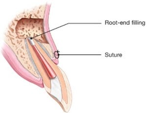 An illustration of an apicoectomy